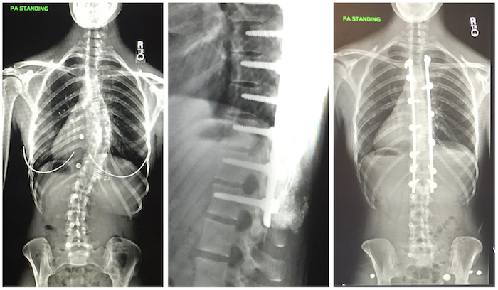 scoliosis surgery, scoliosis x-rays